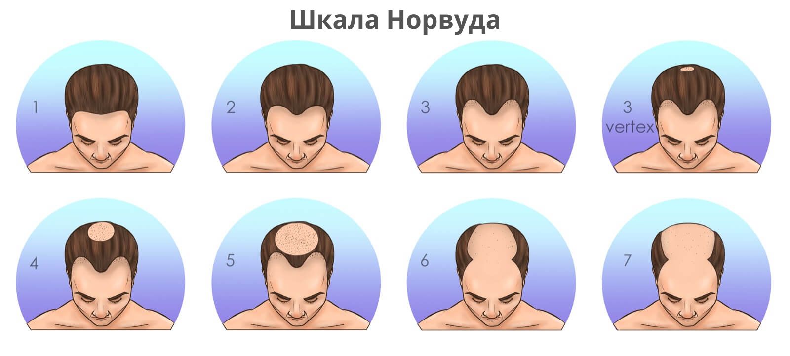 Сколько графтов нужно для пересадки волос - Клиника Heva