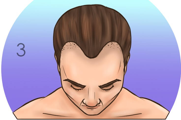 Третья стадия выпадения волос по шкале Норвуда