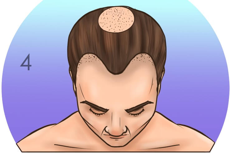 Четвертая стадия выпадения волос по шкале Норвуда