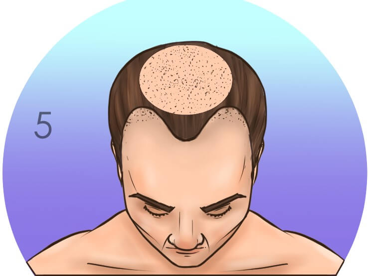 Пятая стадия выпадения волос по шкале Норвуда