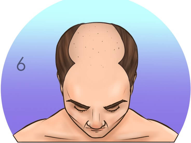 Шестая стадия выпадения волос по шкале Норвуда