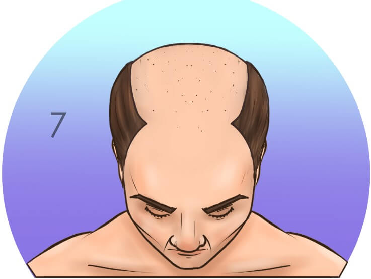 Шестая стадия выпадения волос по шкале Норвуда