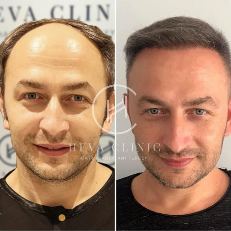 Пересадка волос в Турции – до и после - 5000-4000 графтов у мужчин – фото 2
