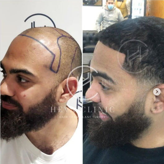 Пересадка волос в Турции – до и после - 5000-4000 графтов у мужчин – фото 3