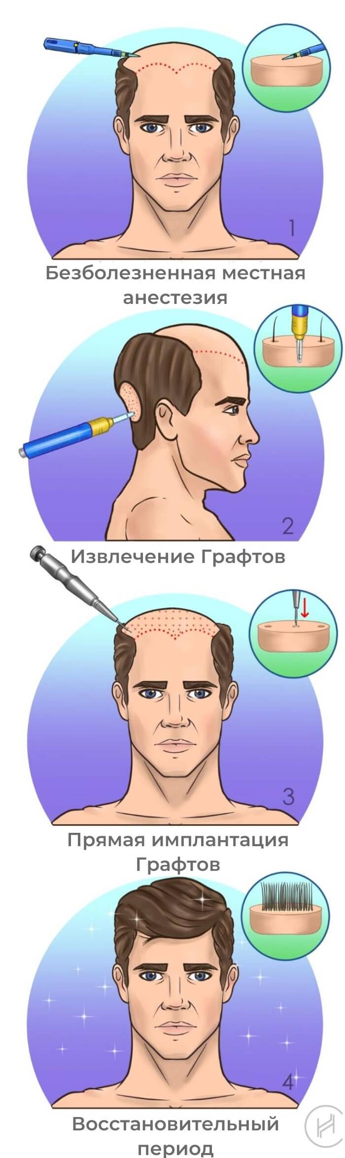 Пересадка волос методом DHI - 4 шага