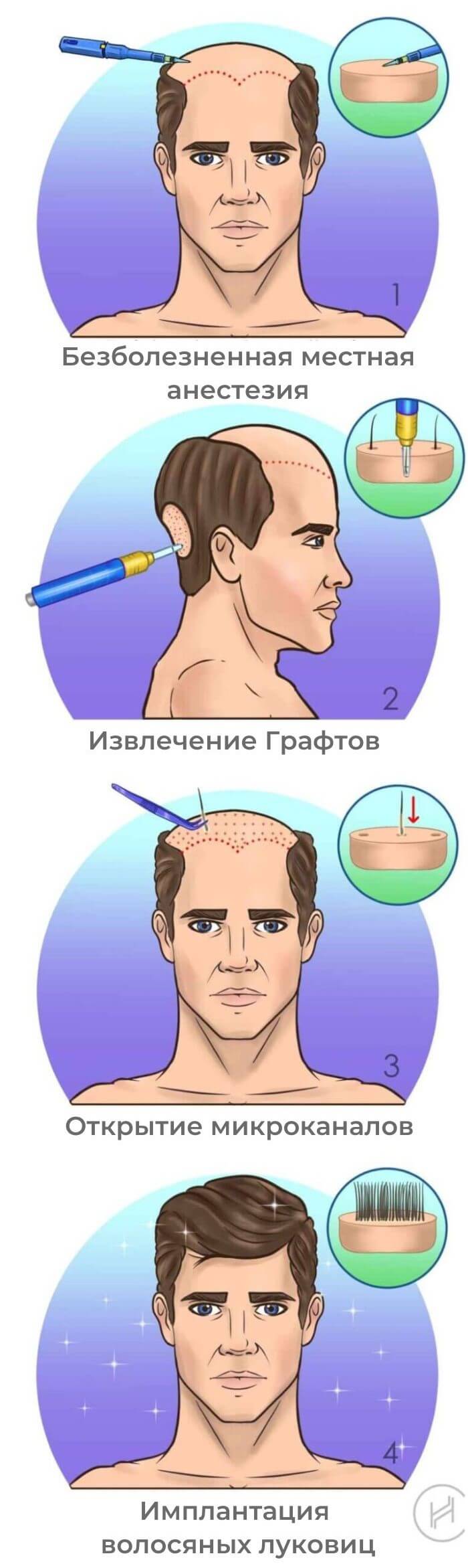 Пересадка волос методом FUE - четыре шага