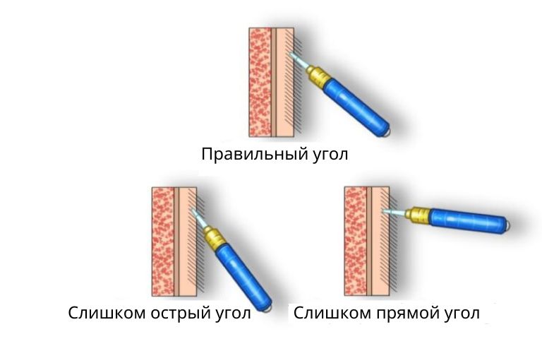 Правильный угол пересадки волос