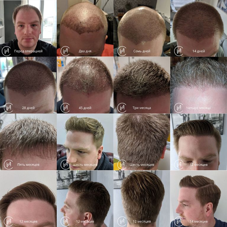 Прогресс после пересадки волос - фото