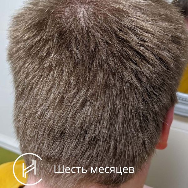 Шесть месяцев после операции по пересадке волос – вид сзади