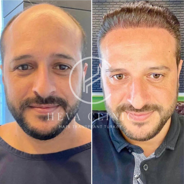 пересадка волос методом FUE - до и после - 4