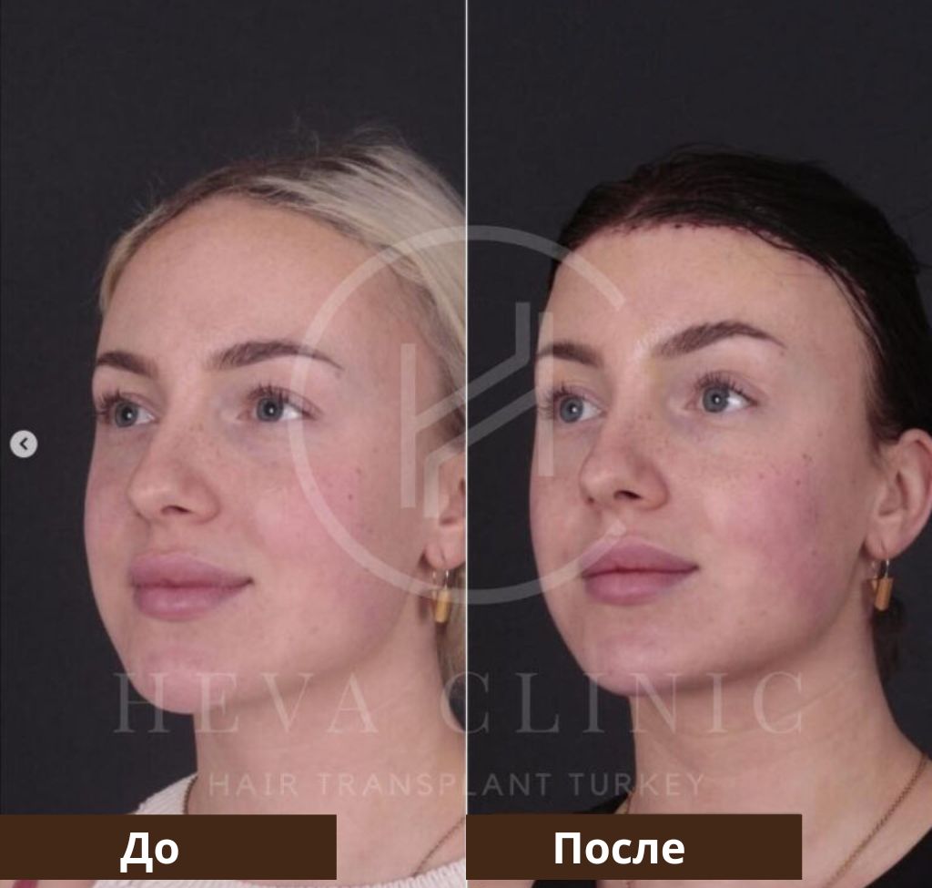 Операция по уменьшению лба до и после