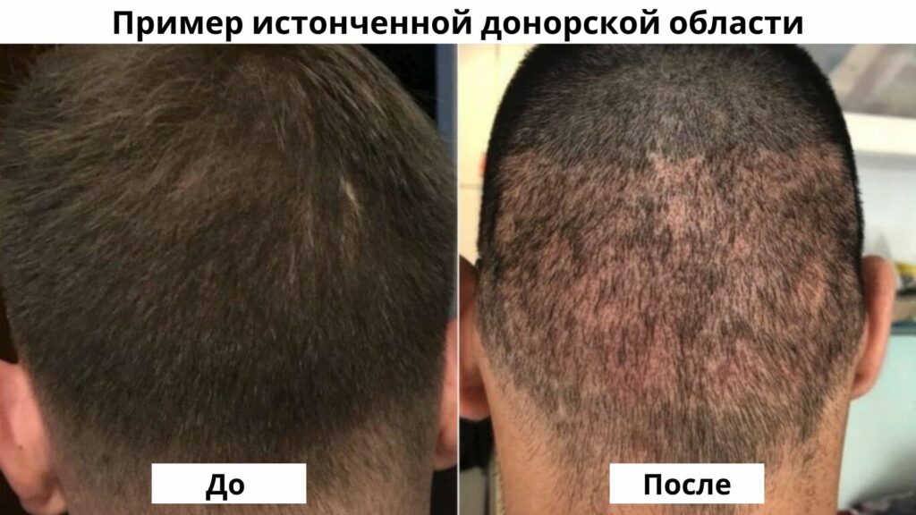 Пересадка волос донорская зона