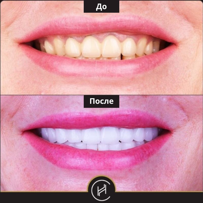 Виниры на зубы в Турции – фото до и после 2