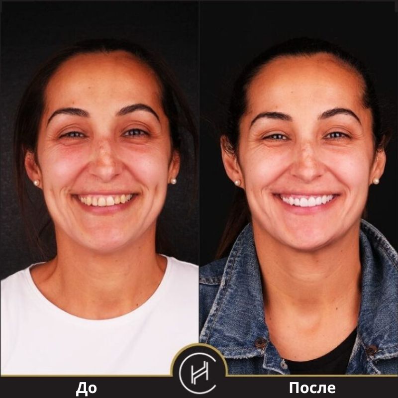 Виниры на зубы в Турции – фото до и после