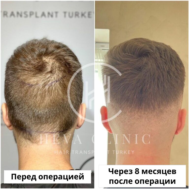 Донорская область до и после пересадки волос