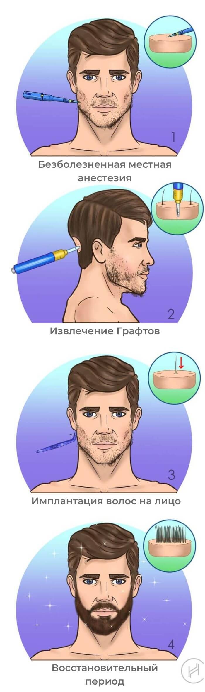 Пересадка бороды - четыре шага