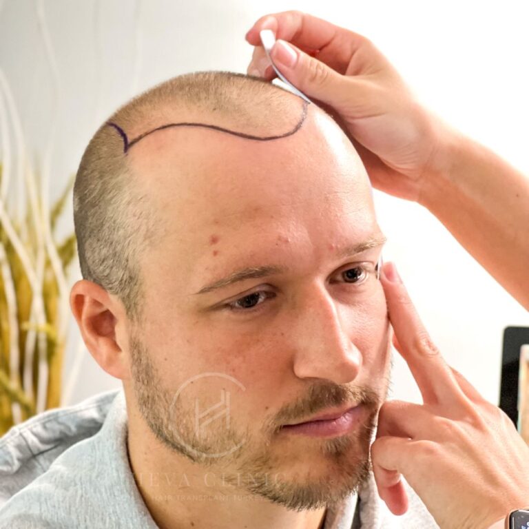 Пересадка волос 5000 графтов в Турции – проведение процедуры