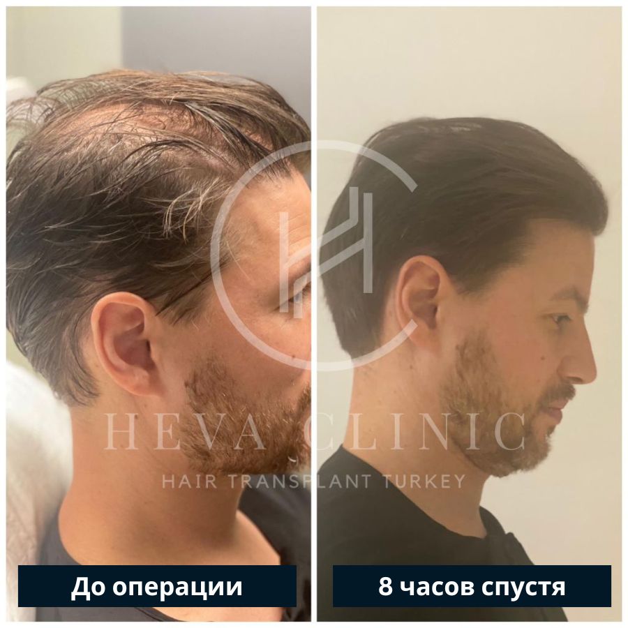 Пересадка волос без бритья реципиентной области - до и после