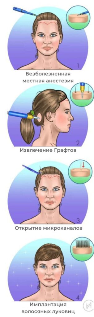 Пересадка волос женщинам методом FUE - четыре шага