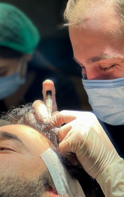 Пересадка волос методом DHI в Турции
