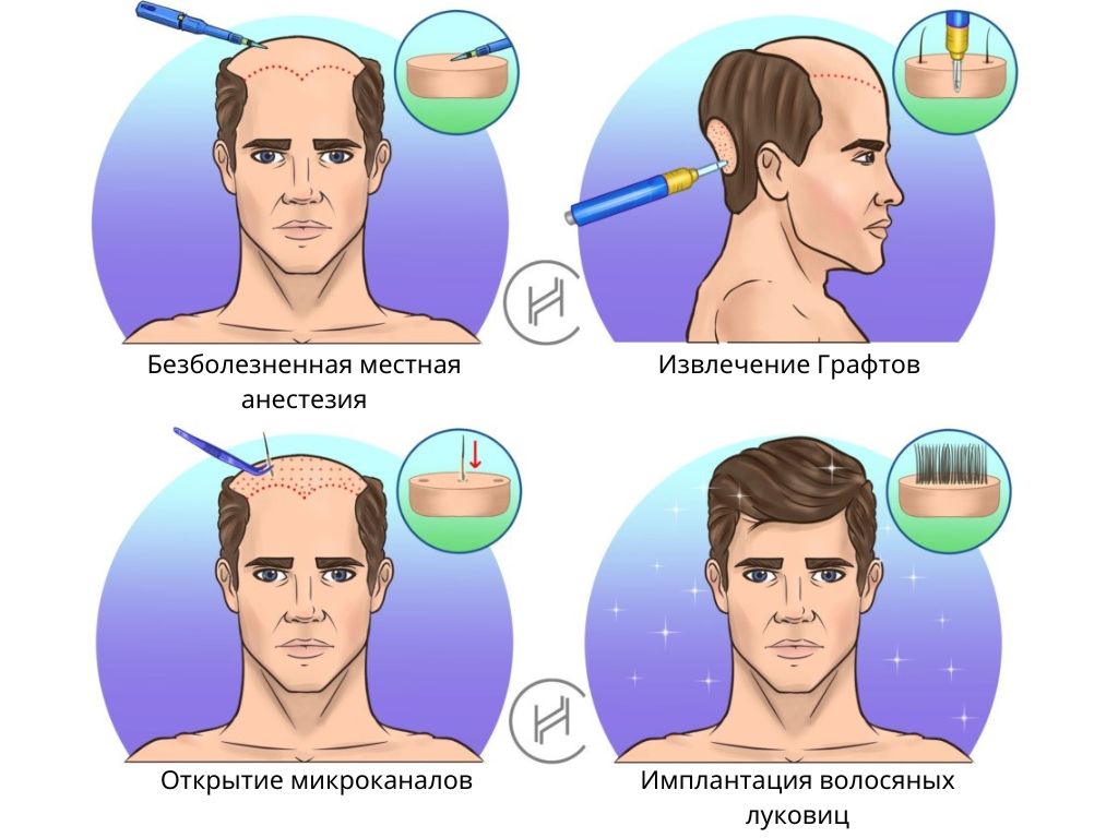 Пересадка волос методом FUE - схема