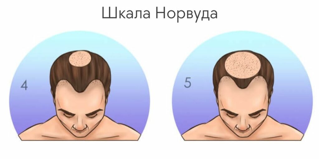 Шкала выпадения волос Норвуда – стадии 4 и 5