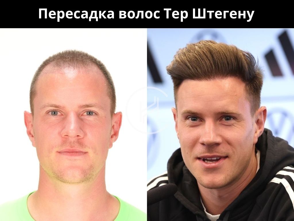Пересадка волос Тер Штегену до и после