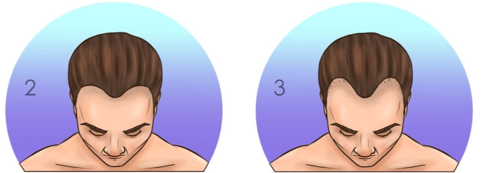 Шкала-выпадения-волос-Норвуда-стадии-2-и-3