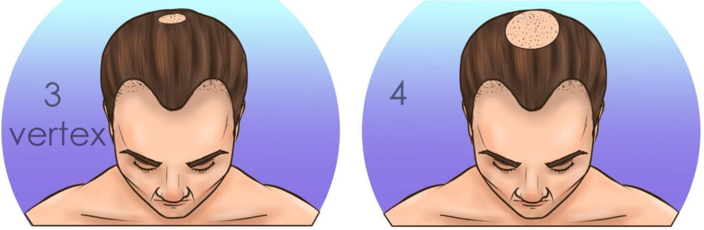 Шкала-выпадения-волос-Норвуда-стадии-3-и-4