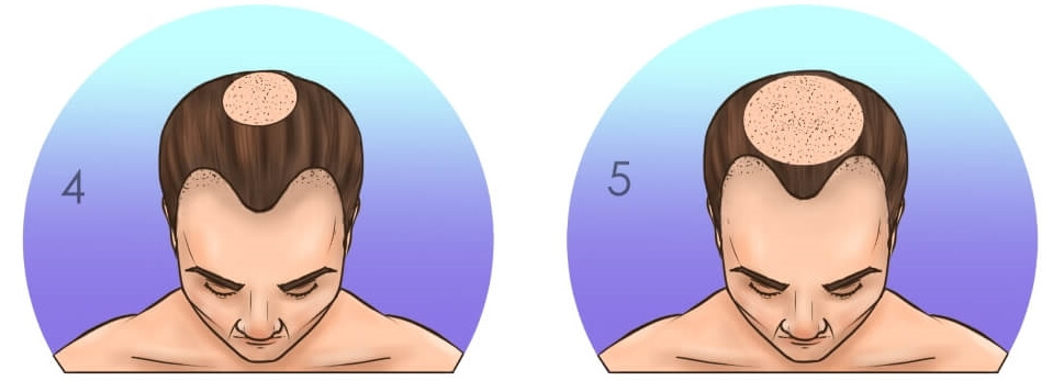 Шкала-выпадения-волос-Норвуда-стадии-4-и-5