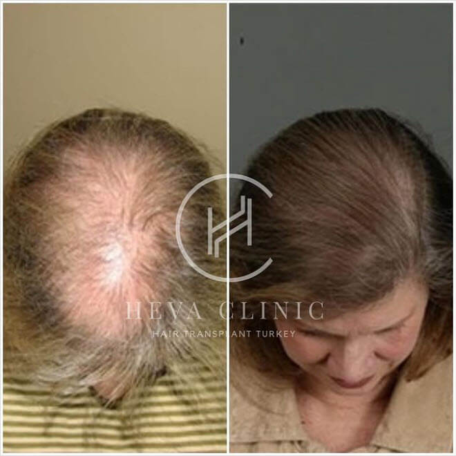 heva clinic kadın saç ekimi öncesi ve sonrası