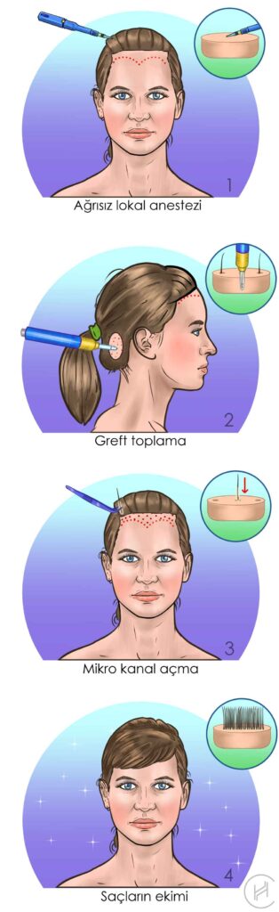 kadın saç ekimi ameliyatı operasyon süreci adımları