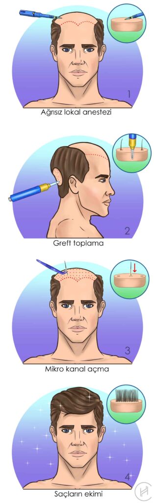 saç ekimi ameliyatı operasyon adımları