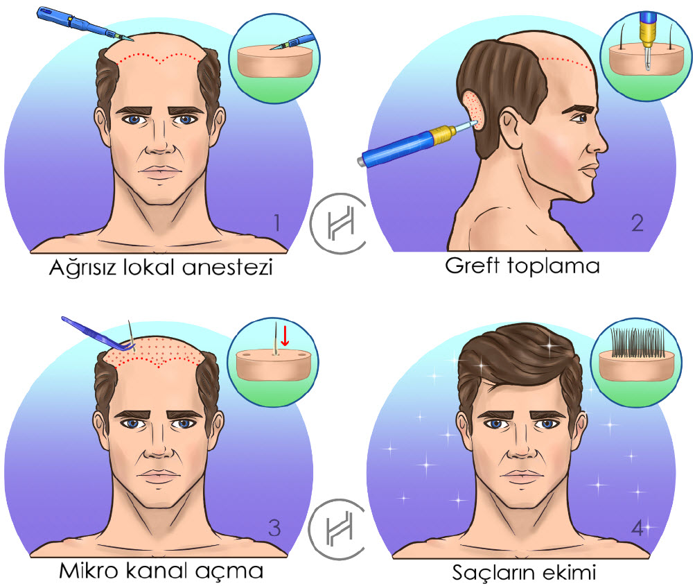 saç ekim süreci adımları kare görsel