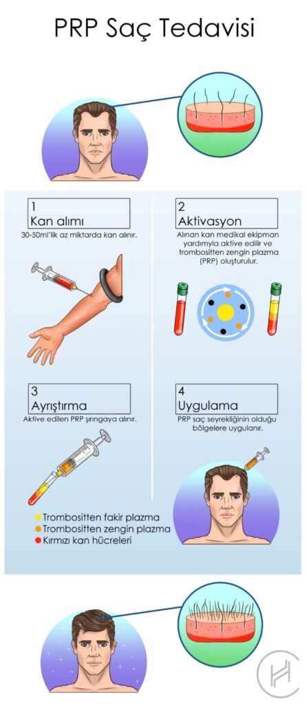 prp plazma saç dökülmesi tedavisi adımları