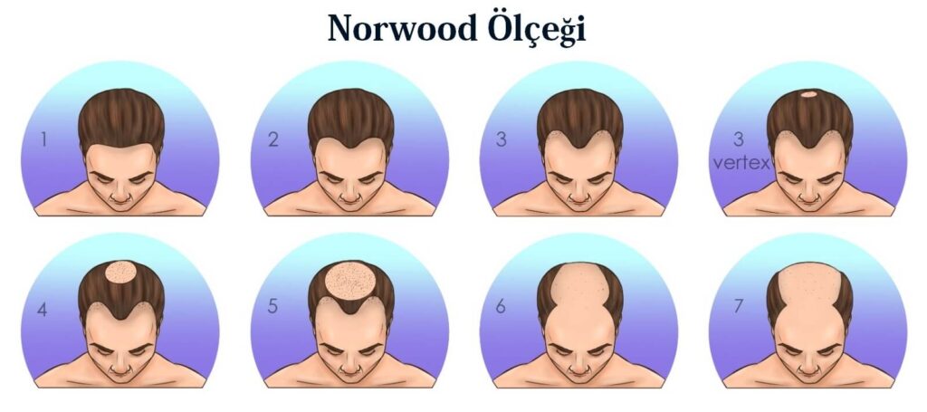 norwood ölçeği saç dökülmesi tipleri