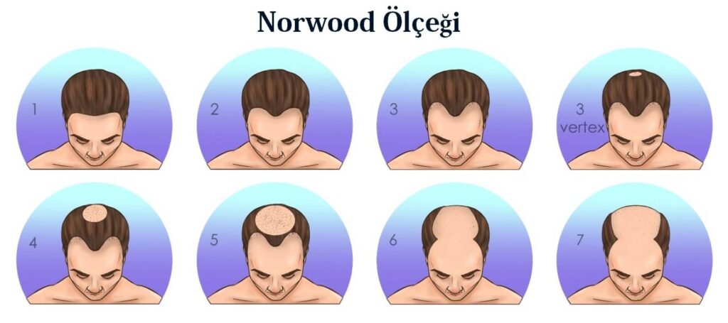 norwood ölçeği saç dökülmesi tipleri