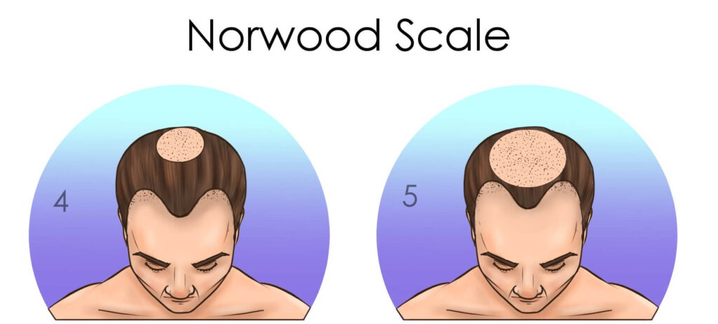 norwood tip 4 ve 5 saç dökülmesi 500 greft