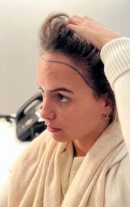 kadın saç ekimi heva clinic saç ekim merkezi