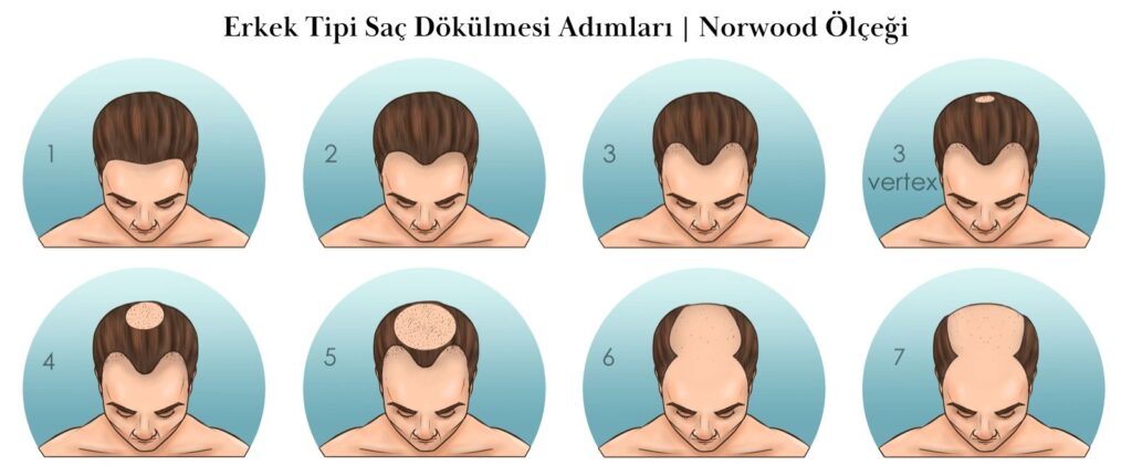 Erkek Tipi Saç Dökülmesi Norwood Ölçeği