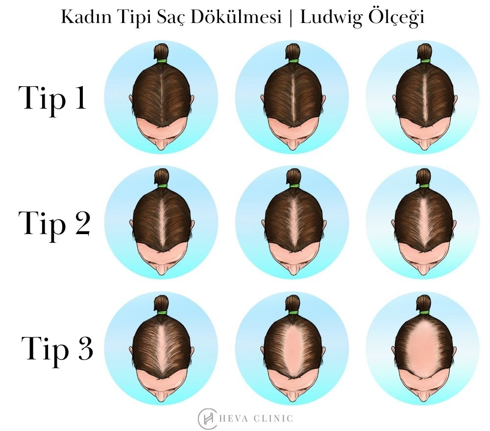 Kadın Tipi Saç Dökülmesi Ludwig Ölçeği