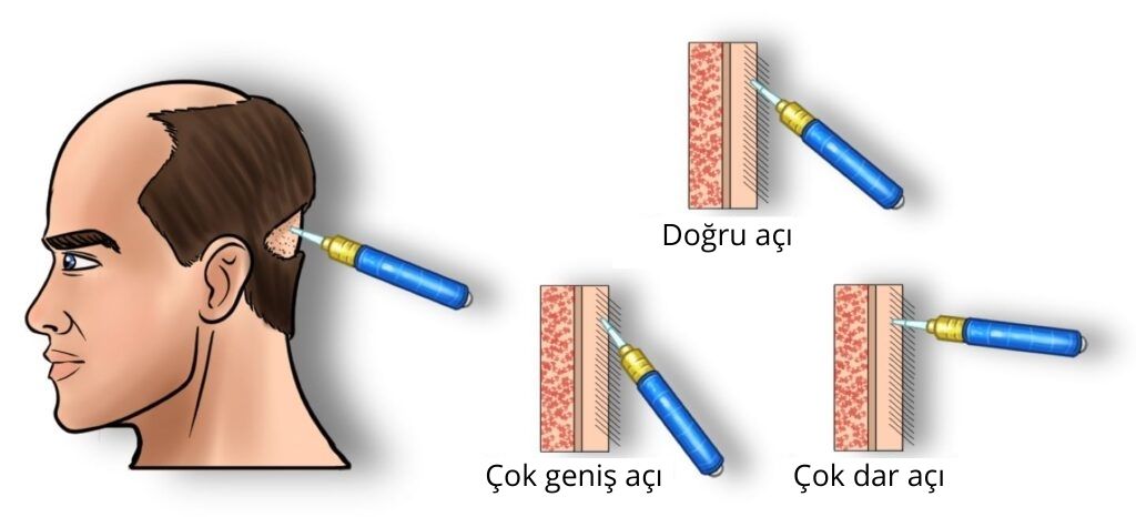 saç grefti toplama açısı