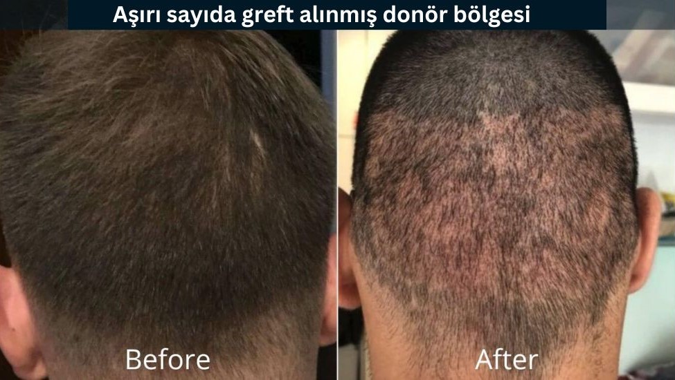 Saç Ekiminde Donör Bölge - İyileşme Süreci ve Bakımı