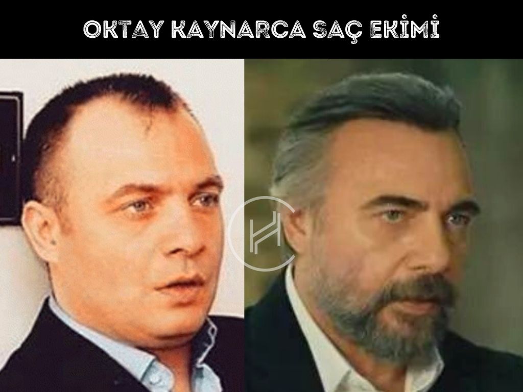 Oktay Kaynarca Saç Ekimi Fotoğrafı
