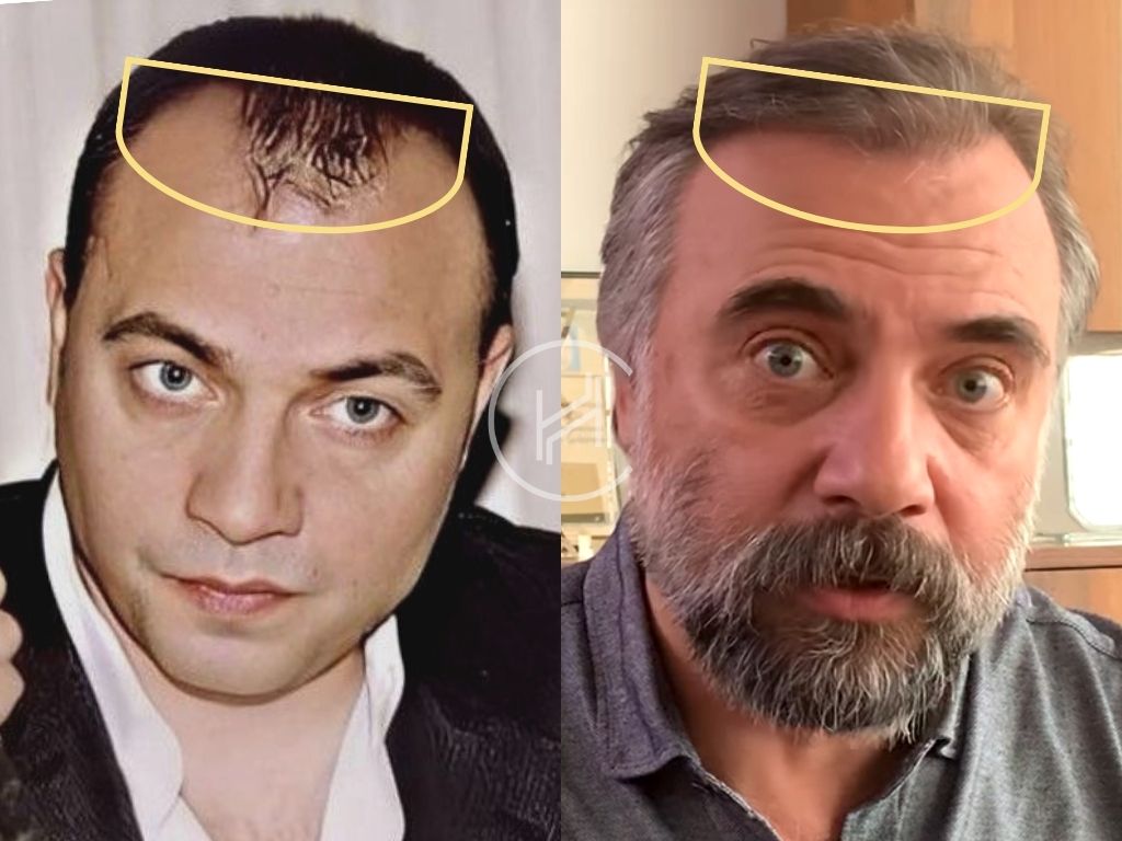 Oktay Kaynarca Saç Ekimi Sonucu Öncesi Sonrası