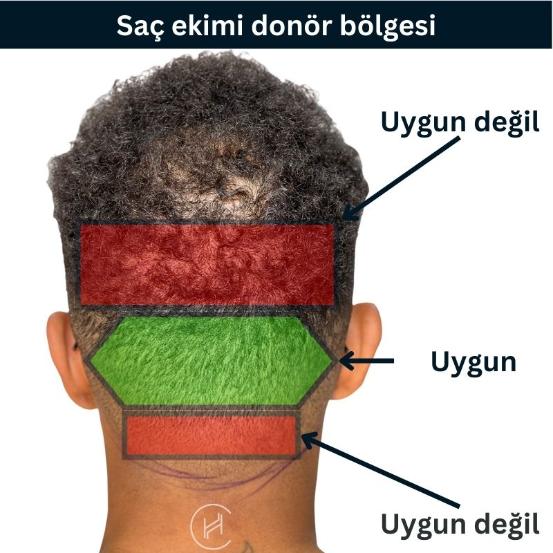 Saç ekimi donör bölgesi uygun ve uygun olmayan bolgeler