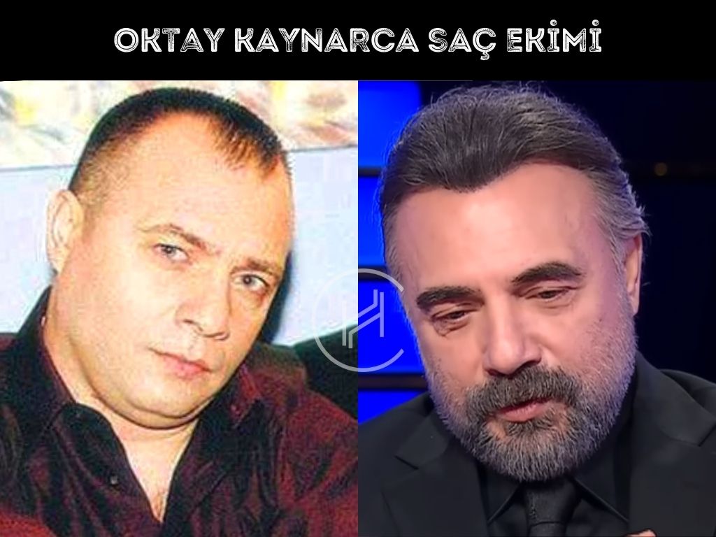 Ünlü Oktay Kaynarca Saç Ekimi Sonuçları