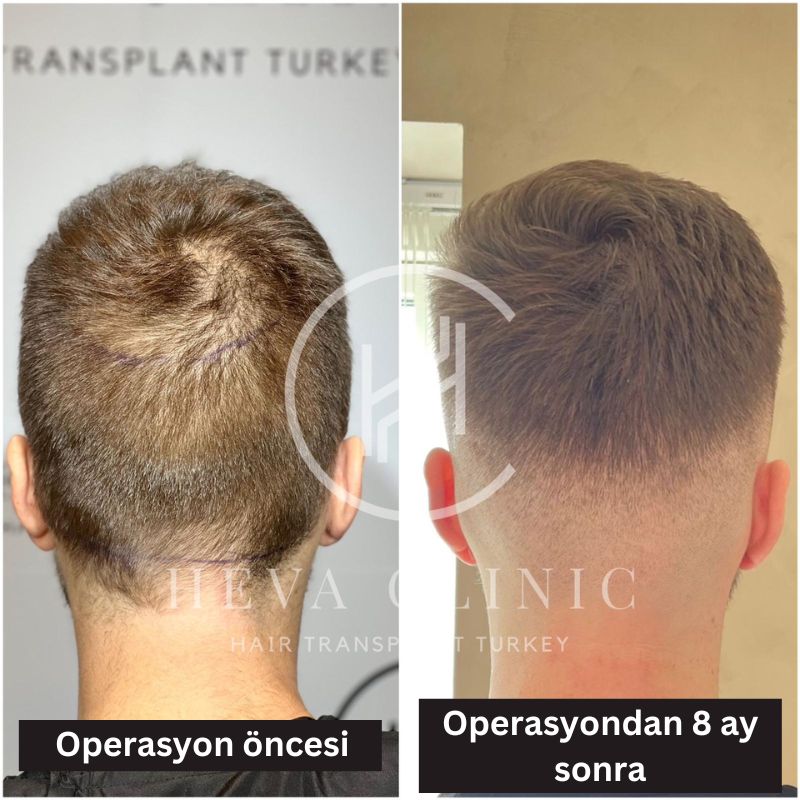 Donör bölgesi saç ekimi öncesi ve 8 ay sonrası fotoğraf karşılaştırma