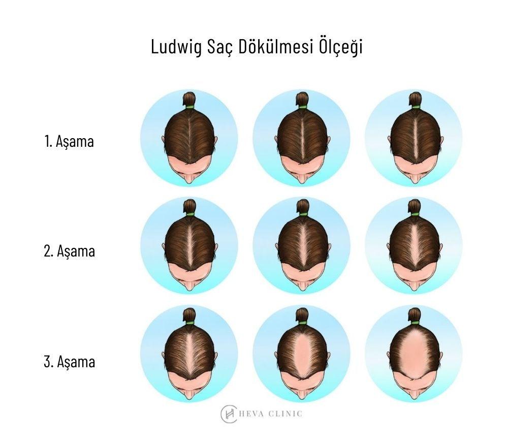 ludwig kadın saç dökülmesi ölçeği