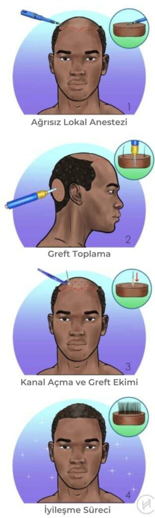 afro saç ekimi süreci ve adımları
